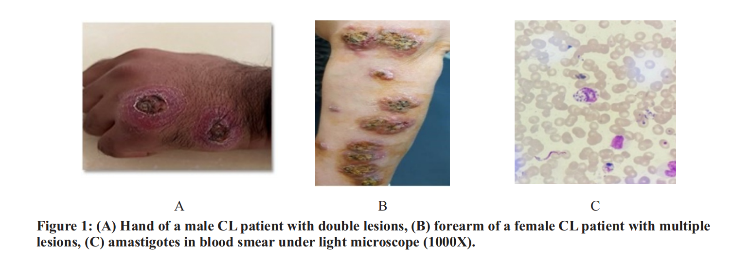 Immunoglobulin E responses in Patients with Cutaneous and Visceral  Leishmaniasis in Iraq